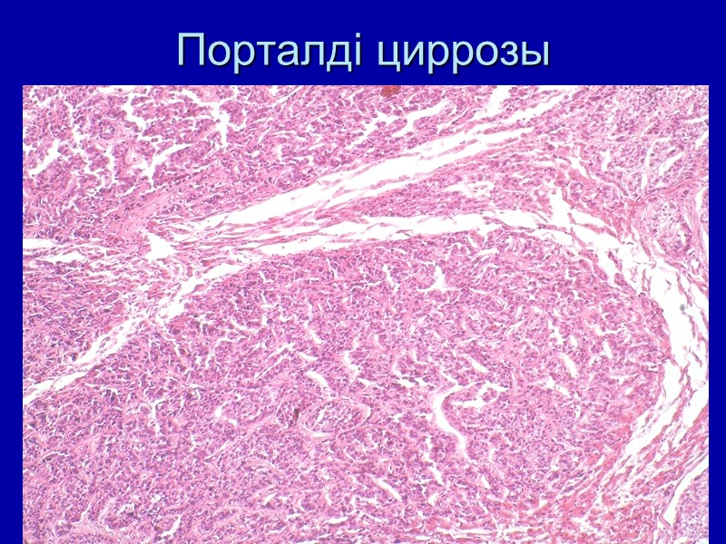 Порталді циррозы